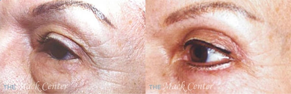 Real Patient before and after facial plastic surgery results in Tampa, FL, performed by Dr. Mack.