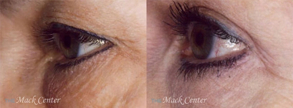 Real Patient before and after facial plastic surgery results in Tampa, FL, performed by Dr. Mack.