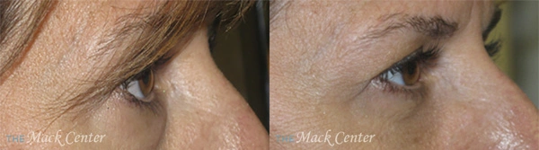 Real Patient before and after facial plastic surgery results in Tampa, FL, performed by Dr. Mack.