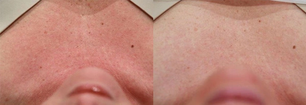 Real Patient before and after facial plastic surgery results in Tampa, FL, performed by Dr. Mack.