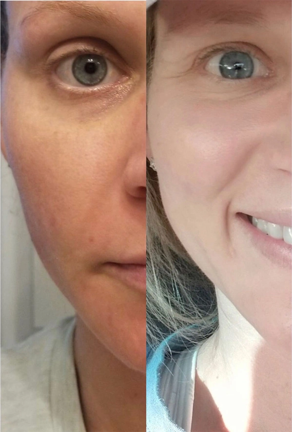 Real Patient before and after facial plastic surgery results in Tampa, FL, performed by Dr. Mack.