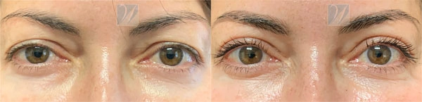 Real Patient before and after facial plastic surgery results in Tampa, FL, performed by Dr. Mack.