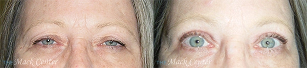 Real Patient before and after facial plastic surgery results in Tampa, FL, performed by Dr. Mack.