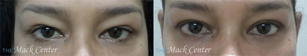 Real Patient before and after facial plastic surgery results in Tampa, FL, performed by Dr. Mack.