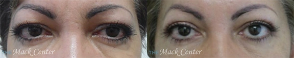 Real Patient before and after facial plastic surgery results in Tampa, FL, performed by Dr. Mack.