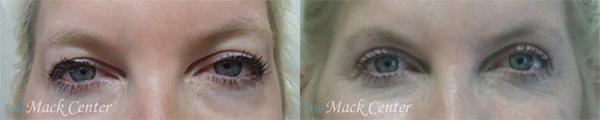Real Patient before and after facial plastic surgery results in Tampa, FL, performed by Dr. Mack.