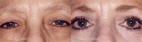 Real Patient before and after facial plastic surgery results in Tampa, FL, performed by Dr. Mack.
