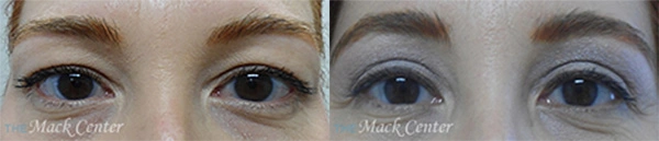 Real Patient before and after facial plastic surgery results in Tampa, FL, performed by Dr. Mack.