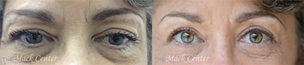 Real Patient before and after facial plastic surgery results in Tampa, FL, performed by Dr. Mack.