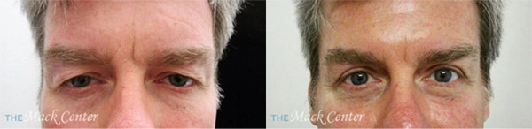 Real Patient before and after facial plastic surgery results in Tampa, FL, performed by Dr. Mack.