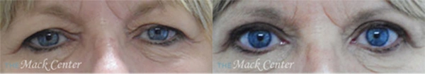 Real Patient before and after facial plastic surgery results in Tampa, FL, performed by Dr. Mack.