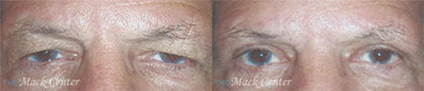 Real Patient before and after facial plastic surgery results in Tampa, FL, performed by Dr. Mack.