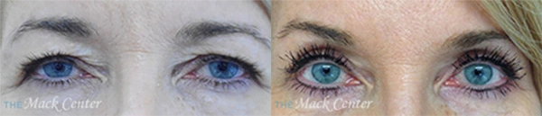 Real Patient before and after facial plastic surgery results in Tampa, FL, performed by Dr. Mack.