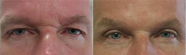 Real Patient before and after facial plastic surgery results in Tampa, FL, performed by Dr. Mack.