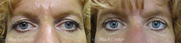Real Patient before and after facial plastic surgery results in Tampa, FL, performed by Dr. Mack.