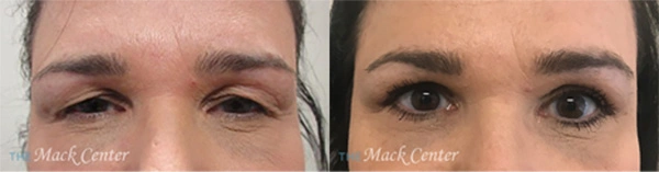 Real Patient before and after facial plastic surgery results in Tampa, FL, performed by Dr. Mack.