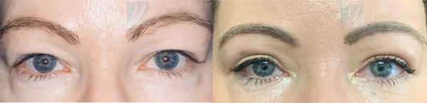 Real Patient before and after facial plastic surgery results in Tampa, FL, performed by Dr. Mack.