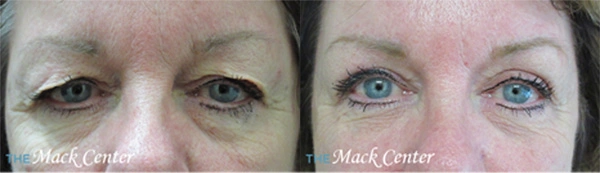 Real Patient before and after facial plastic surgery results in Tampa, FL, performed by Dr. Mack.