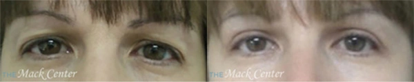 Real Patient before and after facial plastic surgery results in Tampa, FL, performed by Dr. Mack.