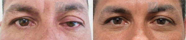 Real Patient before and after facial plastic surgery results in Tampa, FL, performed by Dr. Mack.