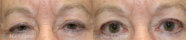 Real Patient before and after facial plastic surgery results in Tampa, FL, performed by Dr. Mack.