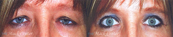Real Patient before and after facial plastic surgery results in Tampa, FL, performed by Dr. Mack.