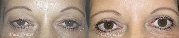 Real Patient before and after facial plastic surgery results in Tampa, FL, performed by Dr. Mack.