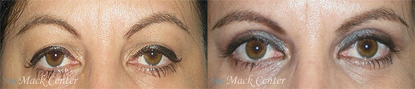 Real Patient before and after facial plastic surgery results in Tampa, FL, performed by Dr. Mack.