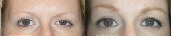 Real Patient before and after facial plastic surgery results in Tampa, FL, performed by Dr. Mack.