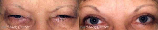 Real Patient before and after facial plastic surgery results in Tampa, FL, performed by Dr. Mack.