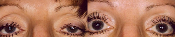 Real Patient before and after facial plastic surgery results in Tampa, FL, performed by Dr. Mack.