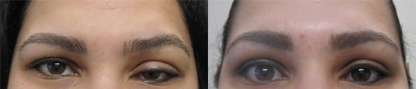 Real Patient before and after facial plastic surgery results in Tampa, FL, performed by Dr. Mack.