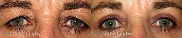 Real Patient before and after facial plastic surgery results in Tampa, FL, performed by Dr. Mack.