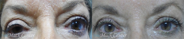 Real Patient before and after facial plastic surgery results in Tampa, FL, performed by Dr. Mack.