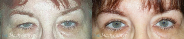 Real Patient before and after facial plastic surgery results in Tampa, FL, performed by Dr. Mack.