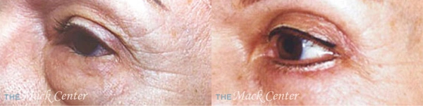 Real Patient before and after facial plastic surgery results in Tampa, FL, performed by Dr. Mack.