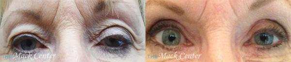 Real Patient before and after facial plastic surgery results in Tampa, FL, performed by Dr. Mack.
