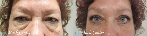Real Patient before and after facial plastic surgery results in Tampa, FL, performed by Dr. Mack.