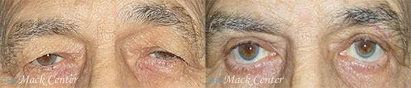 Real Patient before and after facial plastic surgery results in Tampa, FL, performed by Dr. Mack.