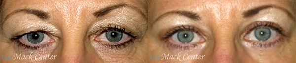 Real Patient before and after facial plastic surgery results in Tampa, FL, performed by Dr. Mack.