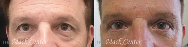 Real Patient before and after facial plastic surgery results in Tampa, FL, performed by Dr. Mack.
