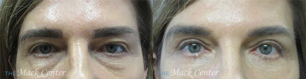 Real Patient before and after facial plastic surgery results in Tampa, FL, performed by Dr. Mack.