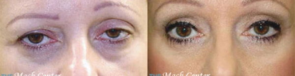 Real Patient before and after facial plastic surgery results in Tampa, FL, performed by Dr. Mack.