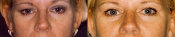 Real Patient before and after facial plastic surgery results in Tampa, FL, performed by Dr. Mack.