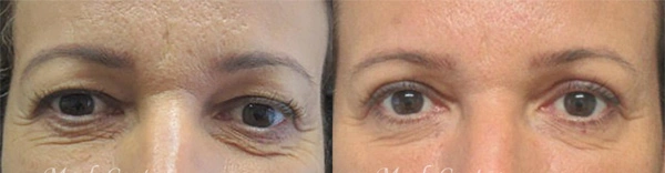 Real Patient before and after facial plastic surgery results in Tampa, FL, performed by Dr. Mack.