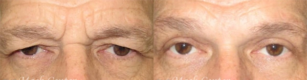 Real Patient before and after facial plastic surgery results in Tampa, FL, performed by Dr. Mack.