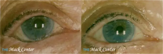 Real Patient Results by Dr. Mack of The Mack Cosmetic Center serving Cashiers Village, NC