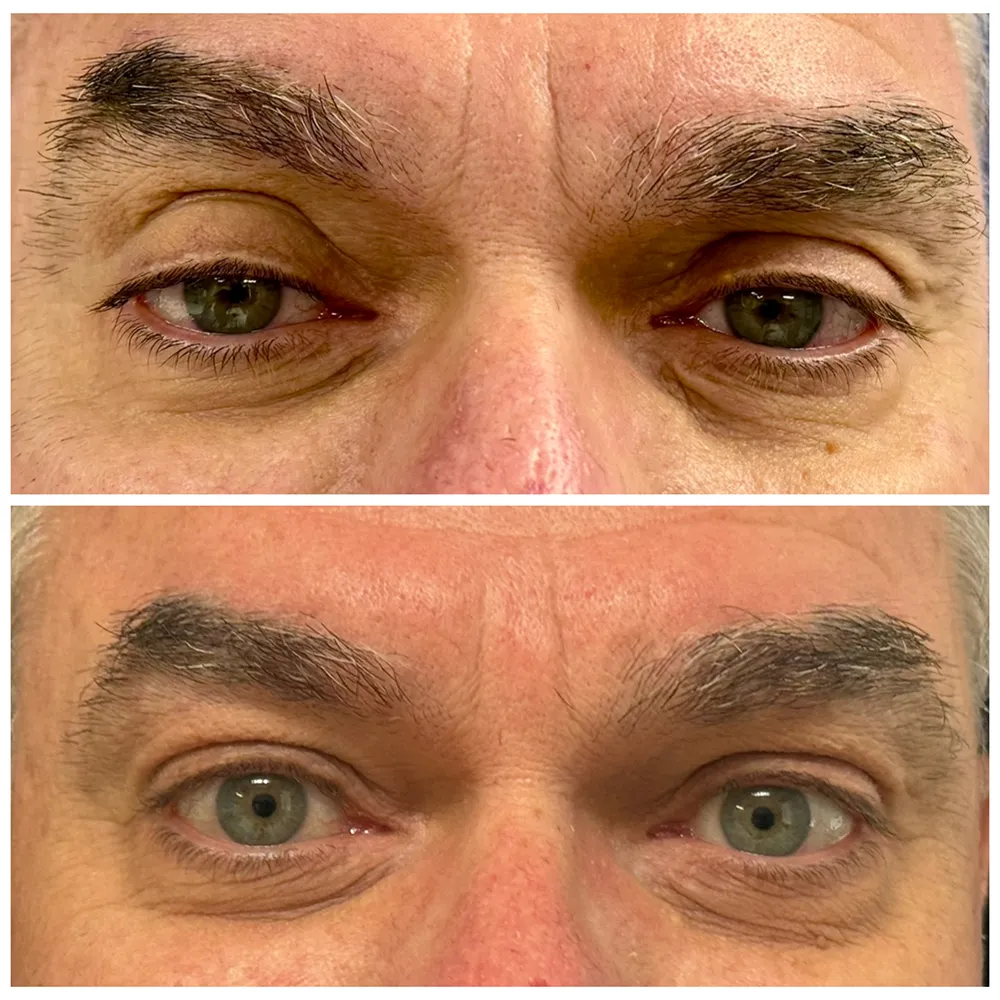 ptosis-reapair_IMG_8983