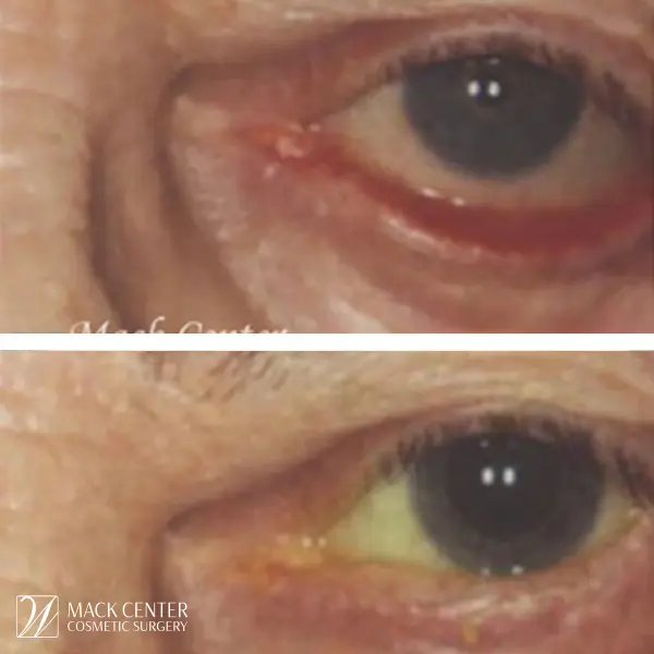 Ectropian Surgery pt1